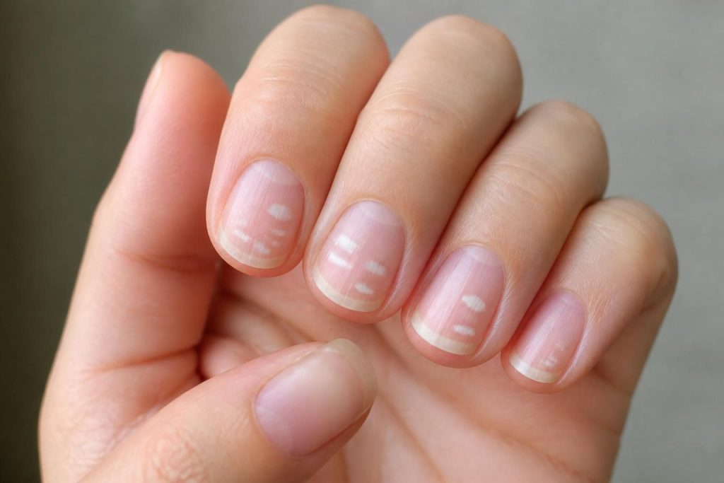 Tache blanche sur les ongles : causes et significations à connaître